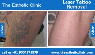 Laser-Tattoo-Removal-treatment-before-after-photos-mumbai-india-1 (5)