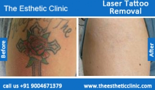 Laser-Tattoo-Removal-treatment-before-after-photos-mumbai-india-1 (6)