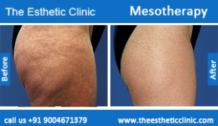 Mesotherapy-treatment-before-after-photos-mumbai-india-1 (2)