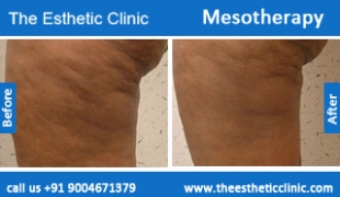 Mesotherapy-treatment-before-after-photos-mumbai-india-1 (3)