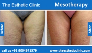 Mesotherapy-treatment-before-after-photos-mumbai-india-1 (4)