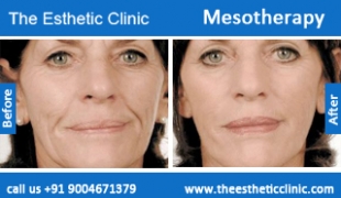 Mesotherapy-treatment-before-after-photos-mumbai-india-1 (5)