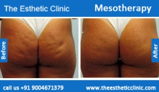 Mesotherapy-treatment-before-after-photos-mumbai-india-1 (6)