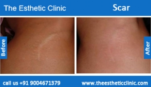 Scars-treatment-before-after-photos-mumbai-india-1 (1)
