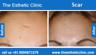 Scars-treatment-before-after-photos-mumbai-india-1 (2)