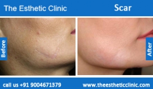 Scars-treatment-before-after-photos-mumbai-india-1 (3)