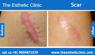 Scars-treatment-before-after-photos-mumbai-india-1 (6)