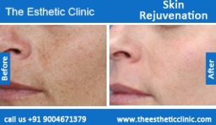 Skin-Rejuvenation-treatment-before-after-photos-mumbai-india-1 (1)