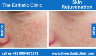 Skin-Rejuvenation-treatment-before-after-photos-mumbai-india-1 (2)