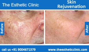 Skin-Rejuvenation-treatment-before-after-photos-mumbai-india-1 (3)