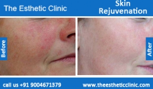 Skin-Rejuvenation-treatment-before-after-photos-mumbai-india-1 (4)