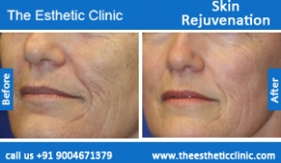 Skin-Rejuvenation-treatment-before-after-photos-mumbai-india-1 (5)