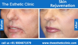Skin-Rejuvenation-treatment-before-after-photos-mumbai-india-1 (6)