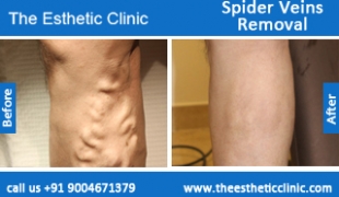 Spider-Veins-Removal-treatment-before-after-photos-mumbai-india-1 (1)