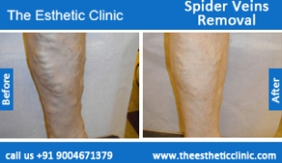 Spider-Veins-Removal-treatment-before-after-photos-mumbai-india-1 (2)