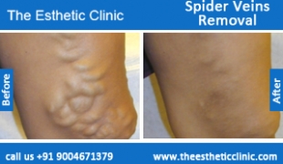 Spider-Veins-Removal-treatment-before-after-photos-mumbai-india-1 (3)