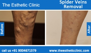 Spider-Veins-Removal-treatment-before-after-photos-mumbai-india-1 (4)