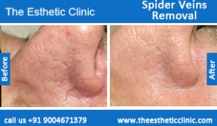 Spider-Veins-Removal-treatment-before-after-photos-mumbai-india-1 (5)