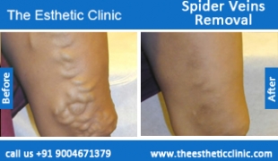 Spider-Veins-Removal-treatment-before-after-photos-mumbai-india-1 (6)