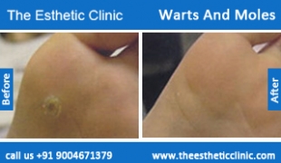 Warts-And-Moles-treatment-before-after-photos-mumbai-india-1 (1)
