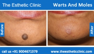 Warts-And-Moles-treatment-before-after-photos-mumbai-india-1 (2)