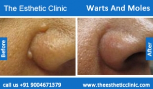 Warts-And-Moles-treatment-before-after-photos-mumbai-india-1 (3)