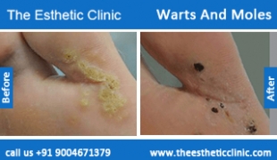 Warts-And-Moles-treatment-before-after-photos-mumbai-india-1 (4)