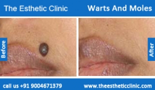 Warts-And-Moles-treatment-before-after-photos-mumbai-india-1 (5)