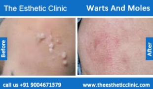 Warts-And-Moles-treatment-before-after-photos-mumbai-india-1 (6)