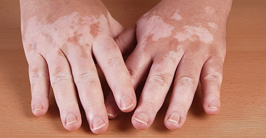 Best Vitiligo and Leucoderma Treatment in India