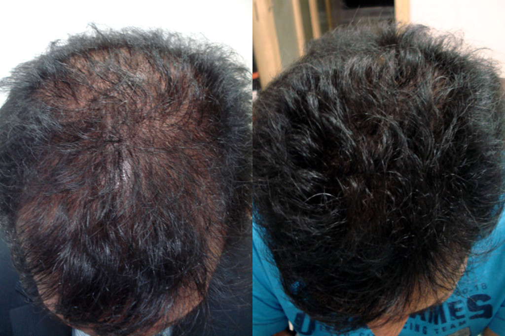 Mesotherapy for hair loss – The best way to promote hair growth - Dr Rinky  Kapoor