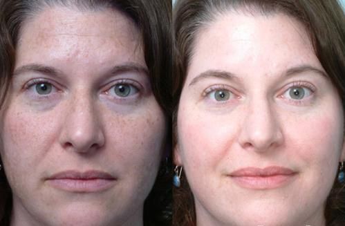 Considering Melasma Treatment Get Rid Of Dark Spots On The Face