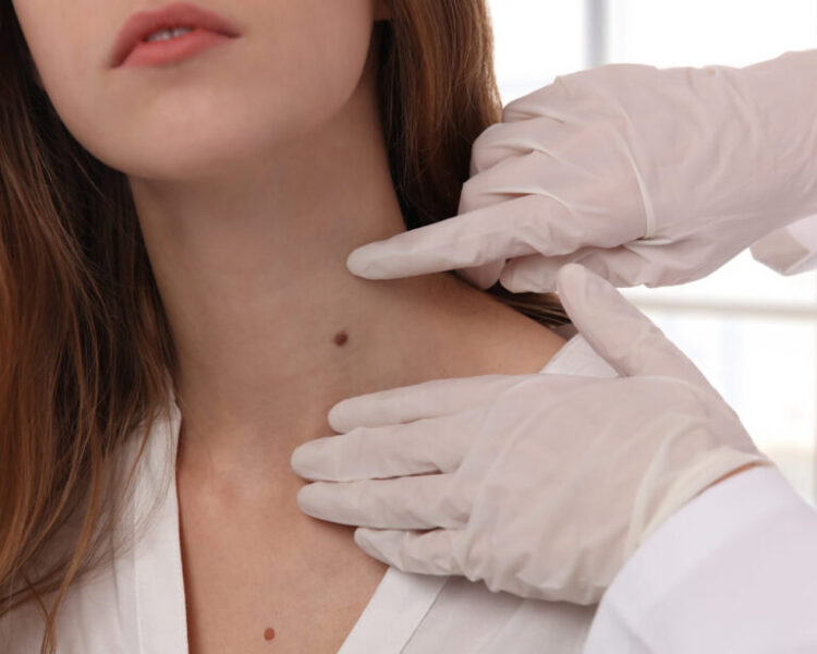 Best Mole Wart Removal Treatment in Mumbai