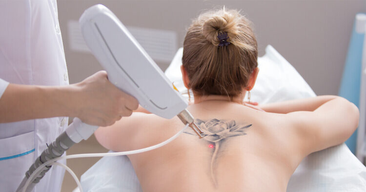 Best Tattoo Removal Treatment in Mumbai