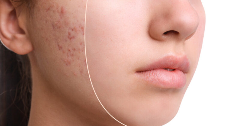 Best Face Scar Treatment in Mumbai (Acne Scar)