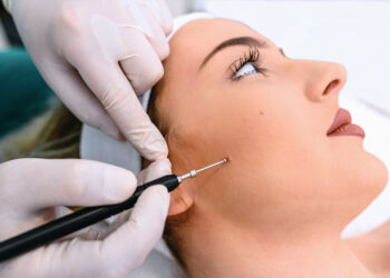 Birthmark Removal Types Of Treatment And Costs in Mumbai