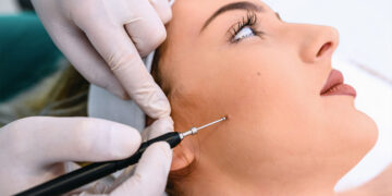 Birthmark Removal Types Of Treatment And Costs in Mumbai