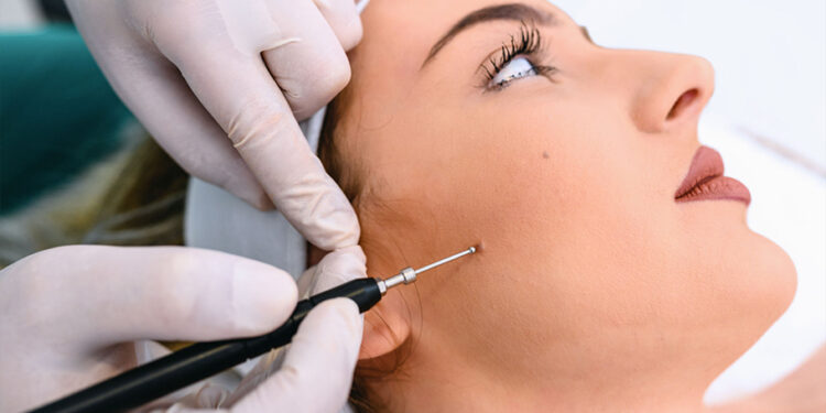 Birthmark Removal Types Of Treatment And Costs in Mumbai