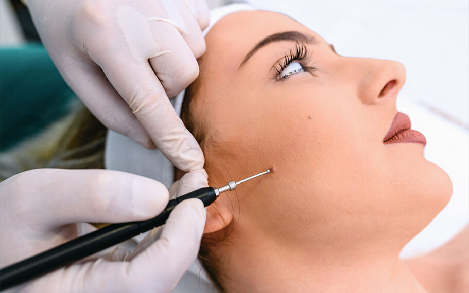 Birthmark Removal Types Of Treatment And Costs in Mumbai