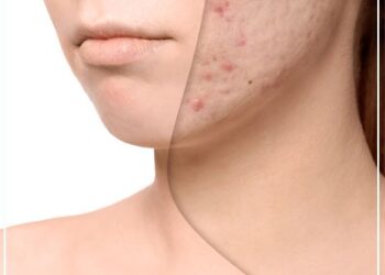 Effective Face Scar Treatment And Scar Reduction Techniques In Mumbai