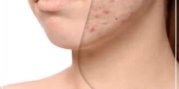 Effective Face Scar Treatment And Scar Reduction Techniques In Mumbai