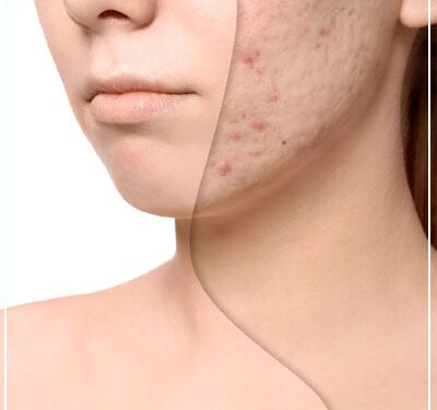 Effective Face Scar Treatment And Scar Reduction Techniques In Mumbai