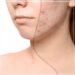 Effective Face Scar Treatment And Scar Reduction Techniques In Mumbai