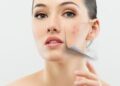 5 Tips for Choosing the Right Dermatologist