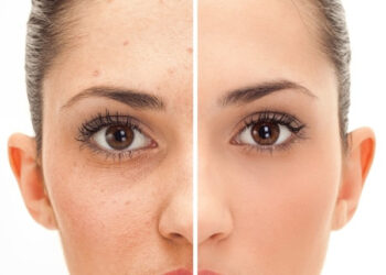 Fractional CO2 Laser Treatment: Risks and Complications