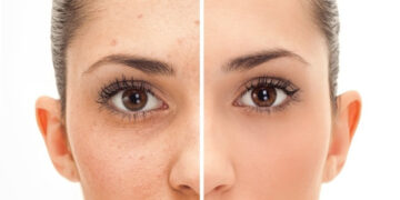 Fractional CO2 Laser Treatment: Risks and Complications