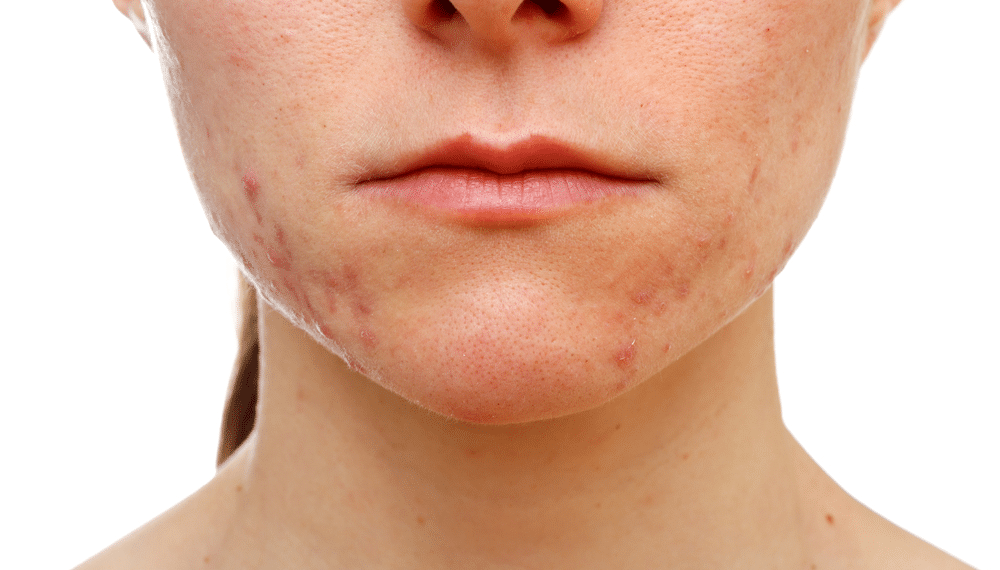 Risks and Side Effects of Face Scar Treatments