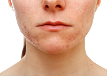 Risks and Side Effects of Face Scar Treatments