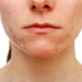 Risks and Side Effects of Face Scar Treatments