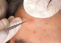 Best Pimple Spot Treatment